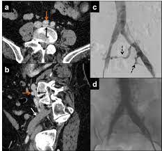 SÍNDROME DE MAY THURNER DIAGNÓSTICO Y TRATAMIENTOS DE UNA PATOLOGÍA VASCULAR QUE ES MÁS FRECUENTE EN LAS MUJERES