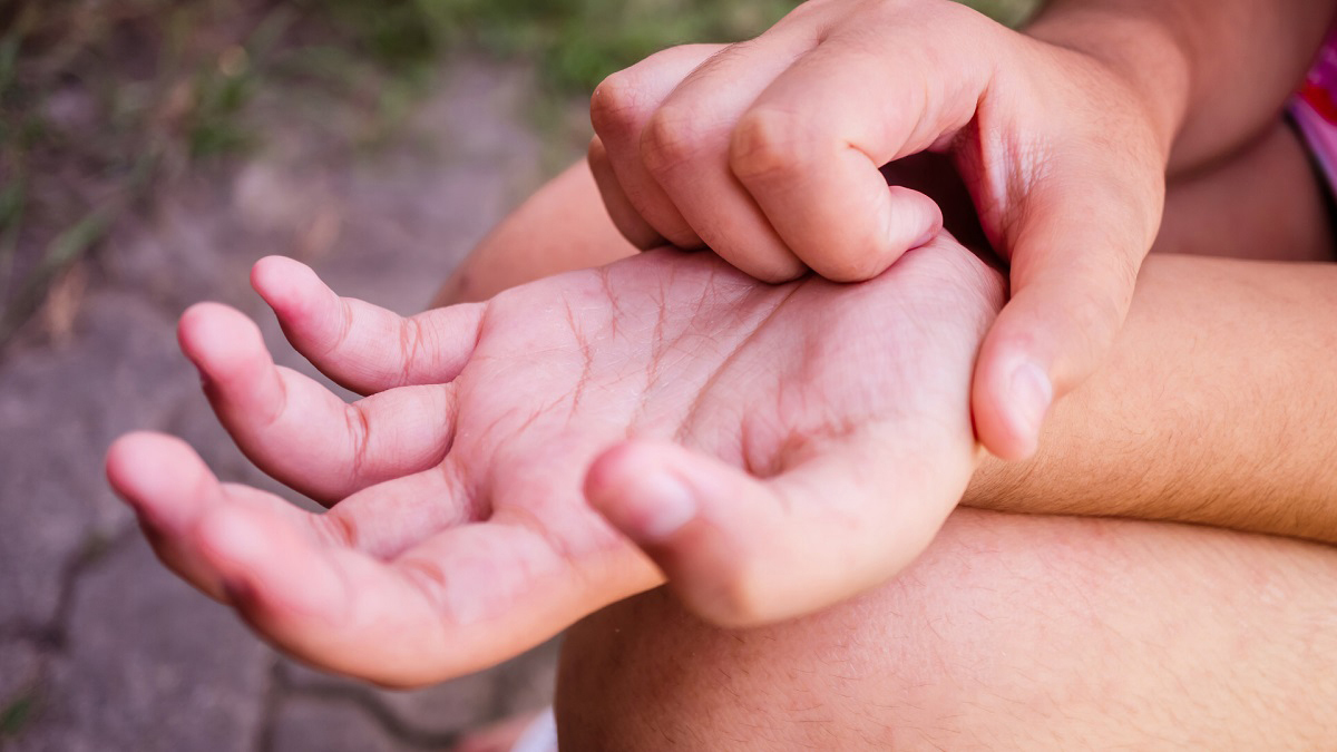 DERMATITIS ATÓPICA CÓMO ES VIVIR CON ESTA CONDICIÓN Y QUÉ FALTA PARA LOGRAR ACCESO UNIVERSAL EN CHILE