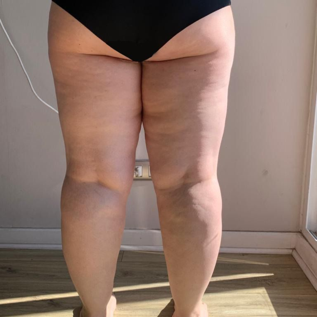 LA LUCHA DE LOS AFECTADOS POR LIPEDEMA PARA QUE LA ENFERMEDAD TENGA COBERTURA DE FONASA E ISAPRES 1
